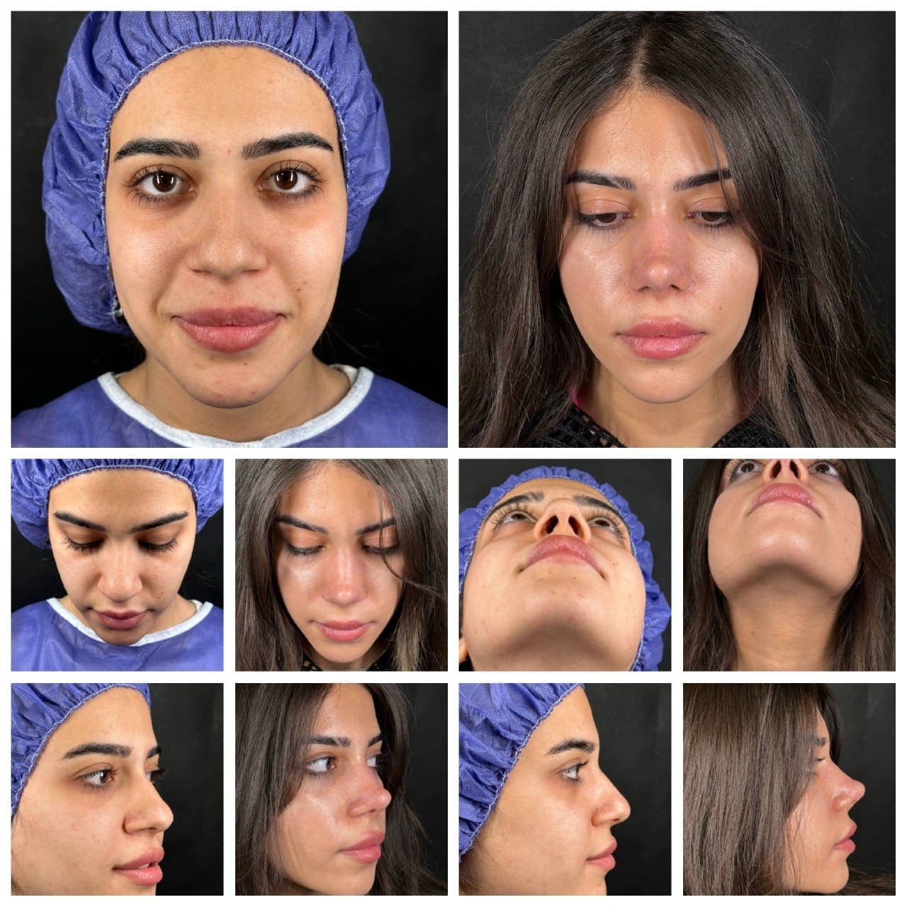 جراحی بینی و زیبایی صورت — نمونه 7