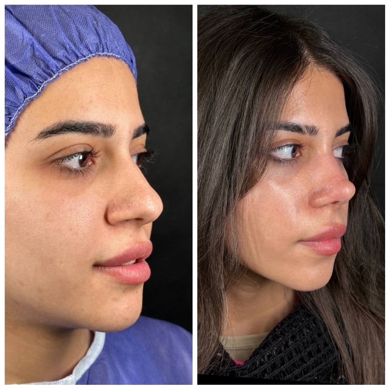 جراحی بینی و زیبایی صورت — نمونه 9