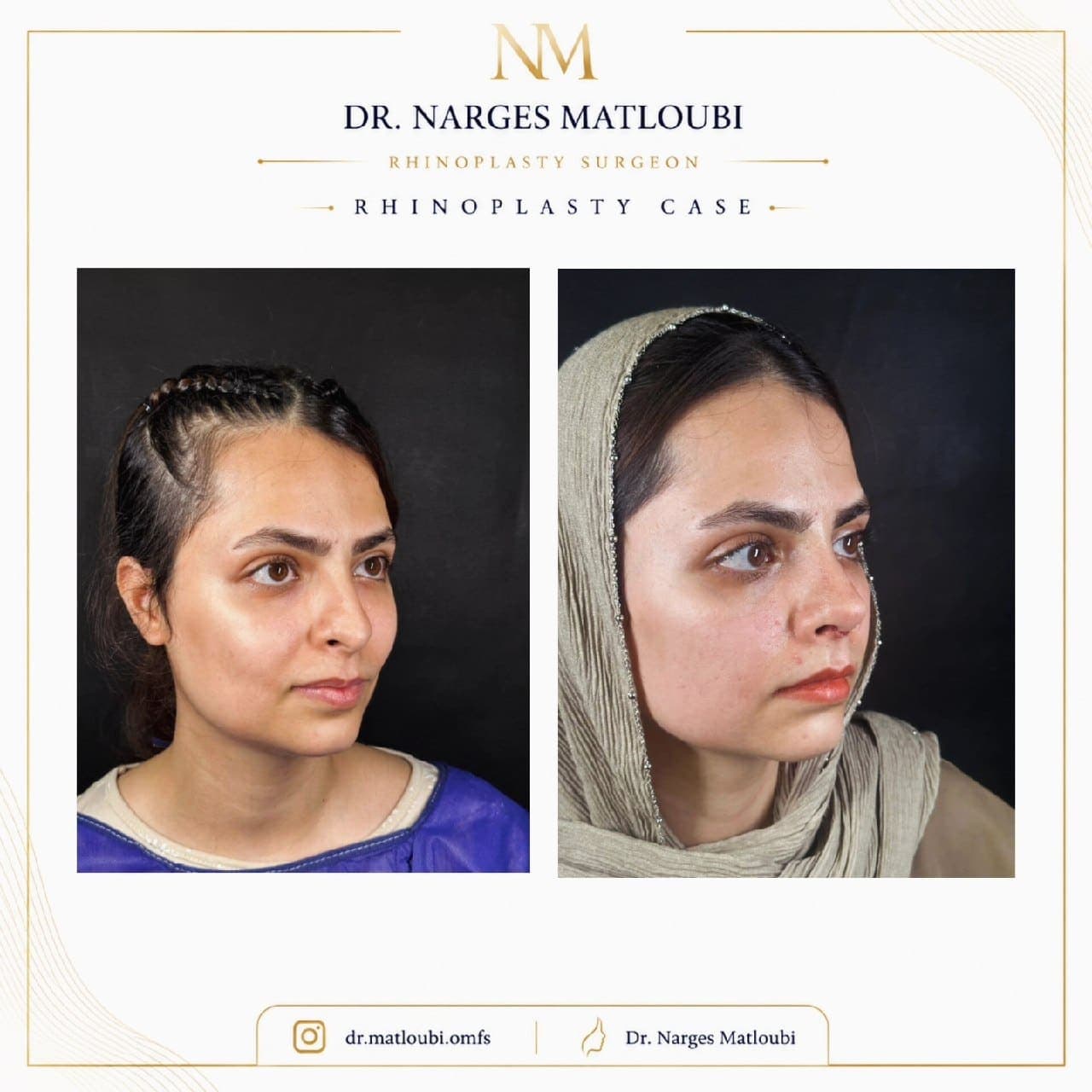 جراحی بینی و زیبایی صورت — نمونه 22