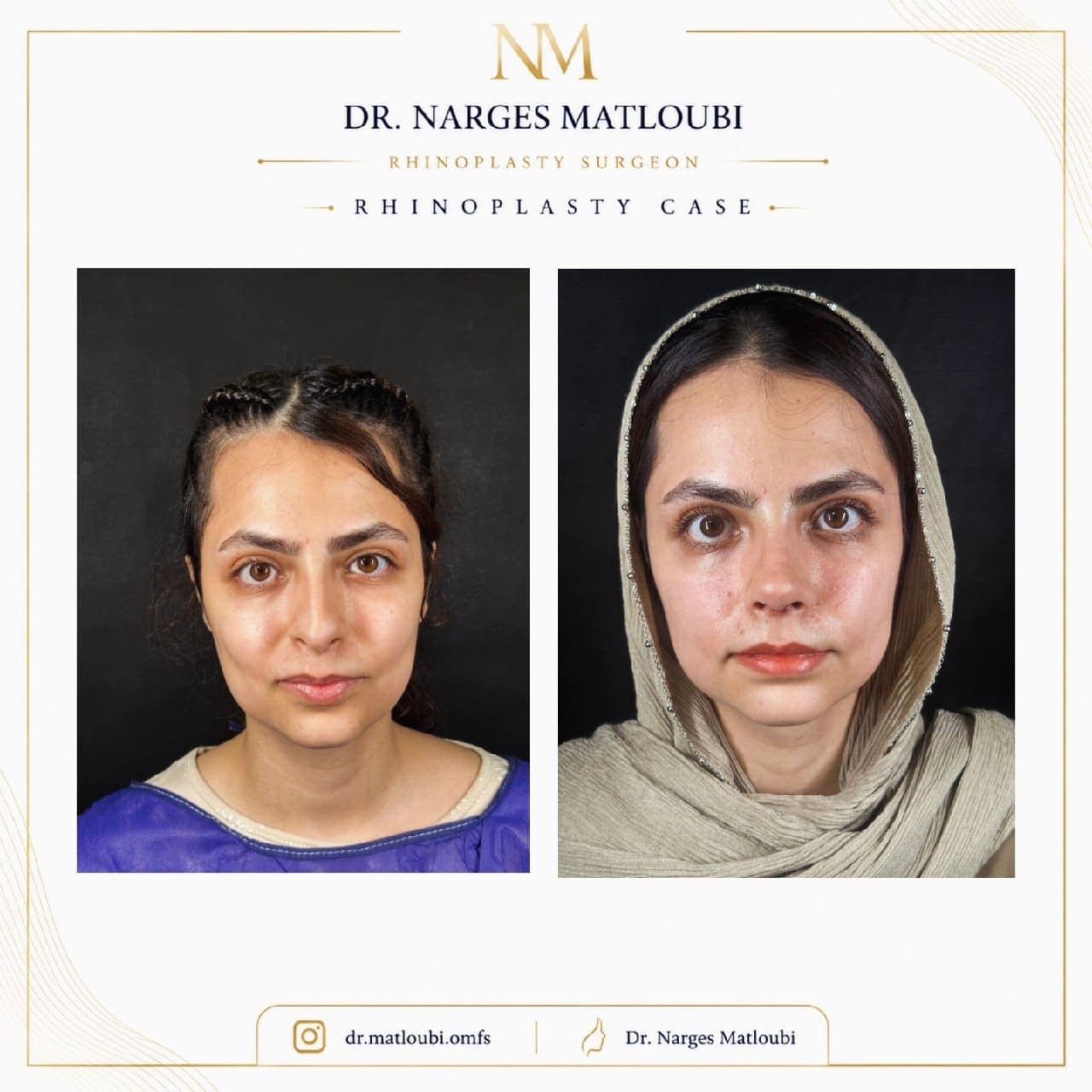 جراحی بینی و زیبایی صورت — نمونه 23