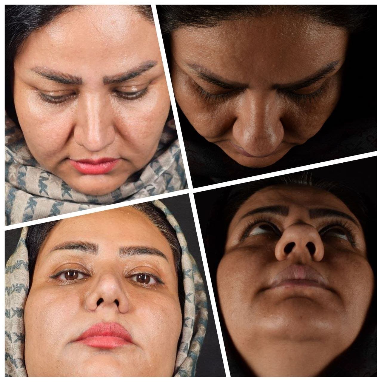 جراحی بینی و زیبایی صورت — نمونه 32